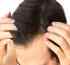Androgenic Alopecia: Treatment Options (Part 2)
