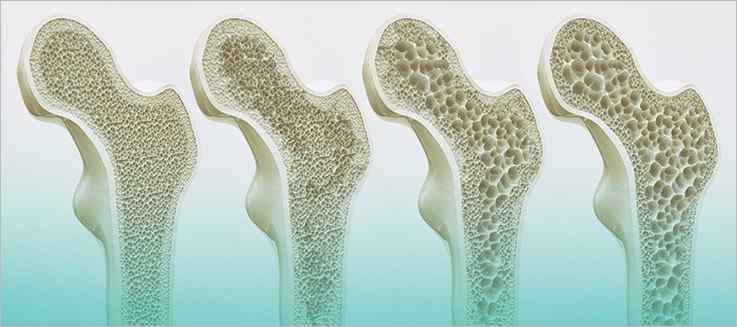 A Closer Look at Bone Density Changes During Menopause