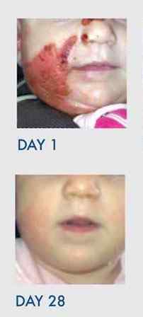 set of images showing improvement in facial burns of a baby