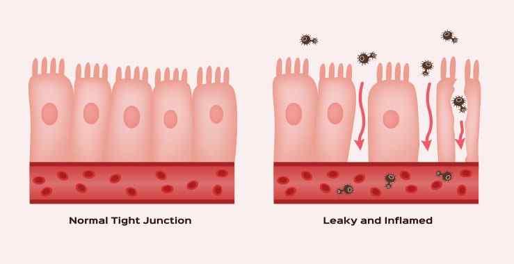 Leaky Gut or Leaky Gut Syndrome