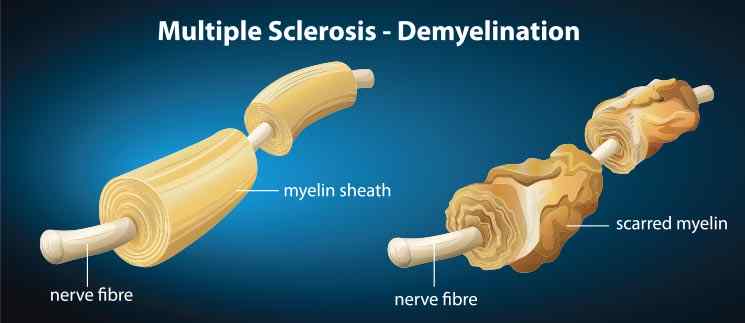 a diagram of multiple sclerosis - demylination