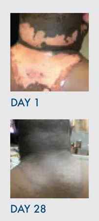 set of images showing improvement in Third-Degree Burn Scarring on the a man's neck, back, and ear