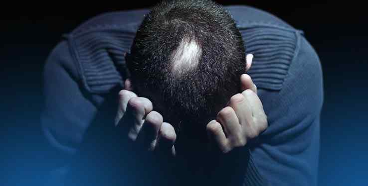 What is alopecia areata