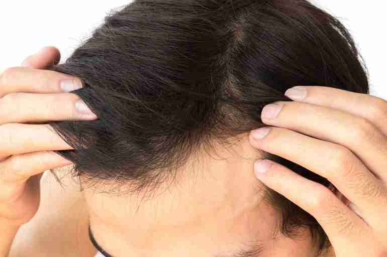 Treatment Options for Androgenic Alopecia - Harbor Compounding