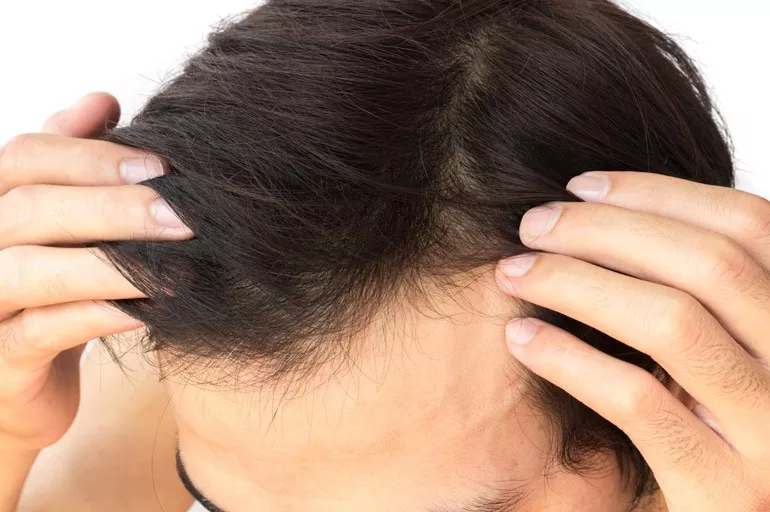 Androgenic Alopecia: Treatment Options (Part 2)