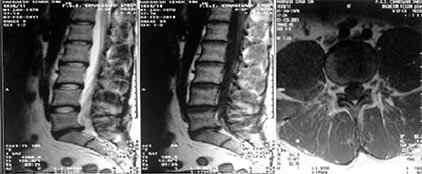 chronic lower back pain x-ray