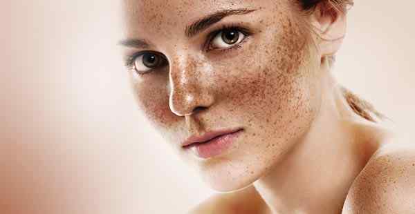 Melasma Treatments: Exploring Beyond Hydroquinone Creams for Hyperpigmentation