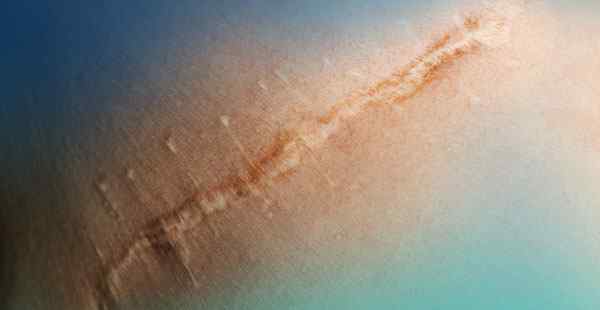 Scar Treatment