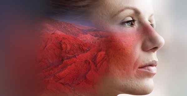 The Masks We Wear: Rosacea Triggers, Treatments, and Compounded Medications