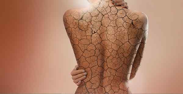 Treatment of psoriasis using Low Dose Naltrexone and Vitamin B12