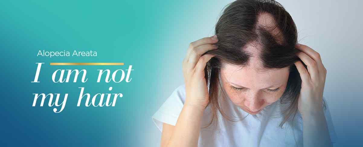 Unconventional Therapies for Alopecia Areata