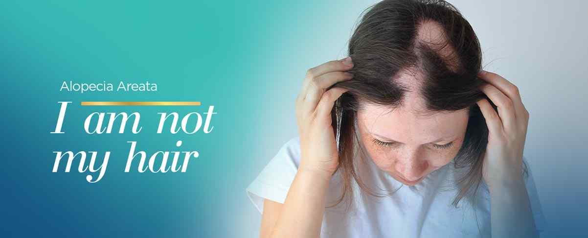 Unconventional Therapies for Alopecia Areata
