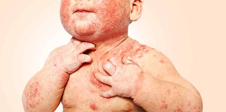a child having eczema