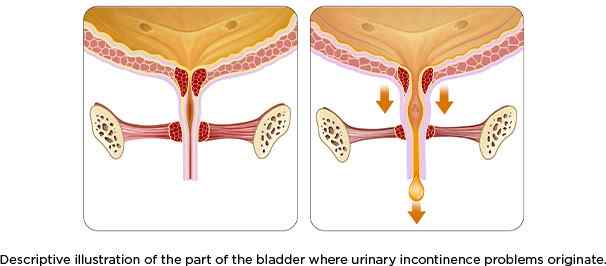 descriptive illustration of the part of the bladder where urainary incontinence problems originate