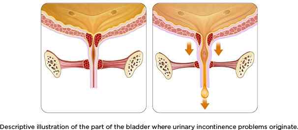 descriptive illustration of the part of the bladder where urainary incontinence problems originate